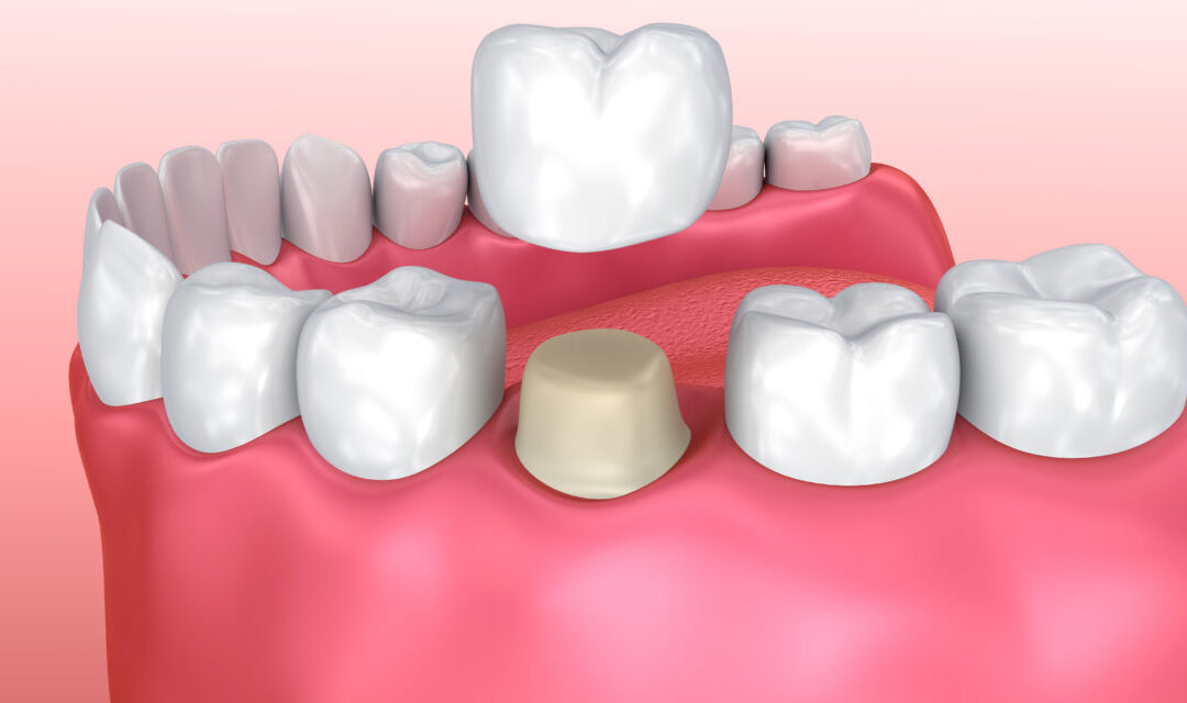 “From Cavities to Crowns: A Guide to Common Dental Procedures”